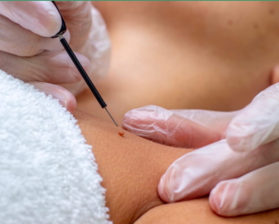 удаление бородавок