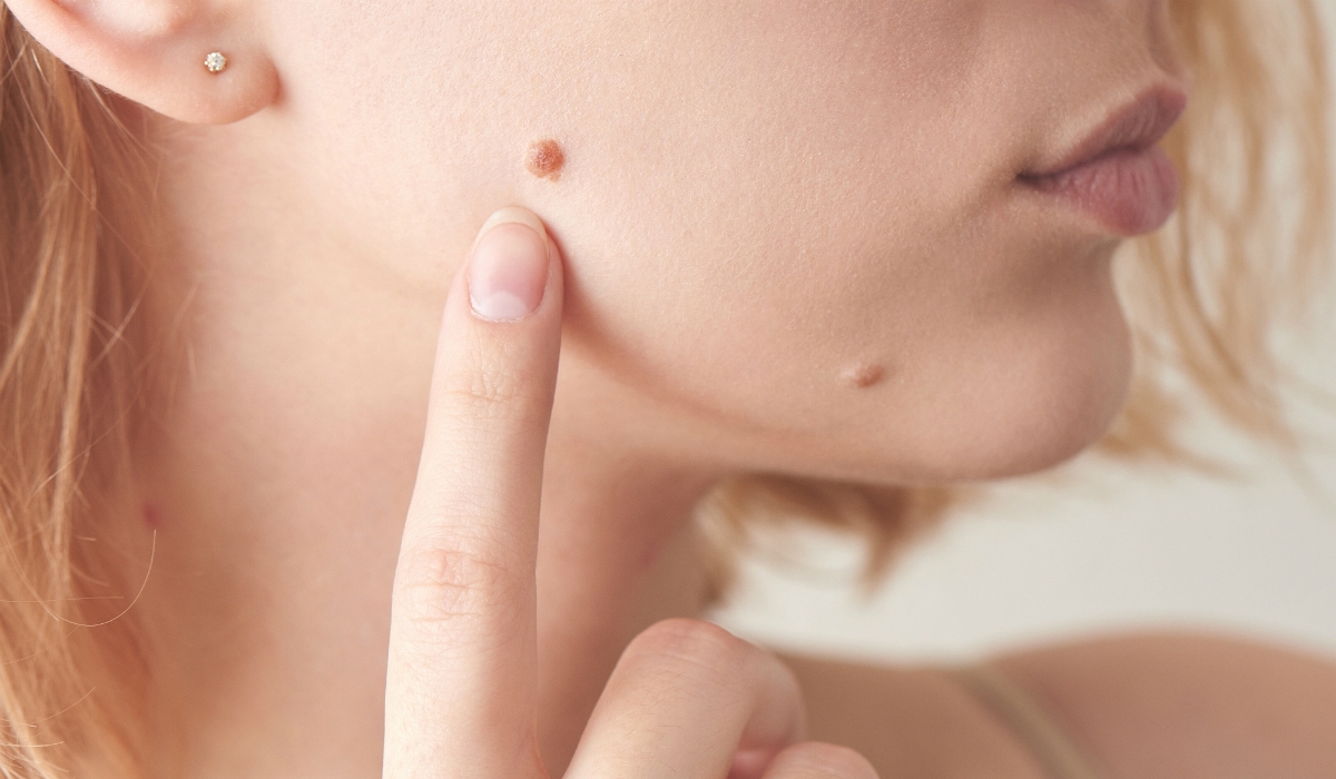 удаление кондиломы