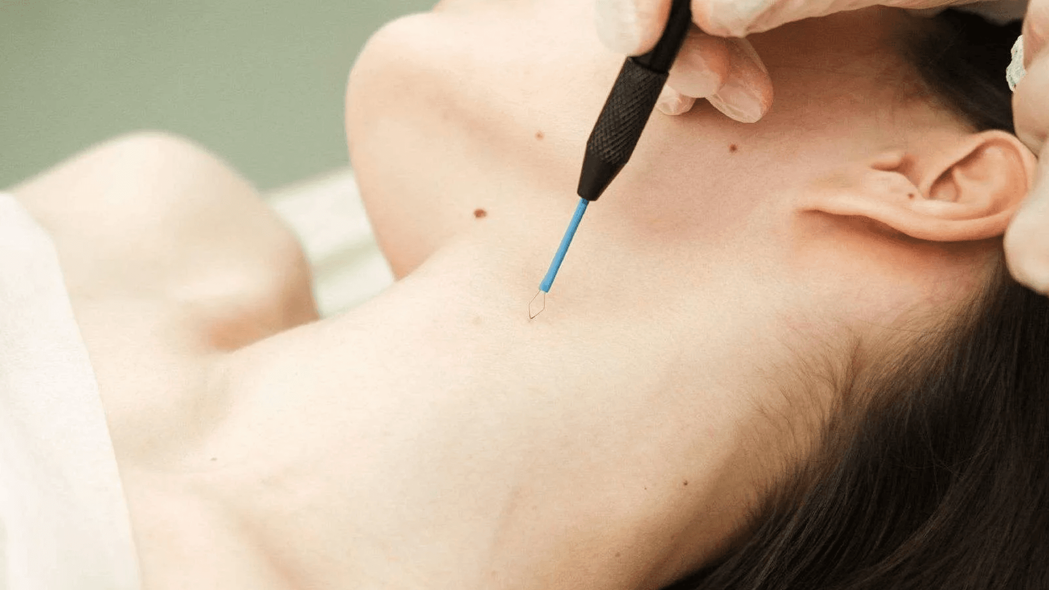 удаление паппилом