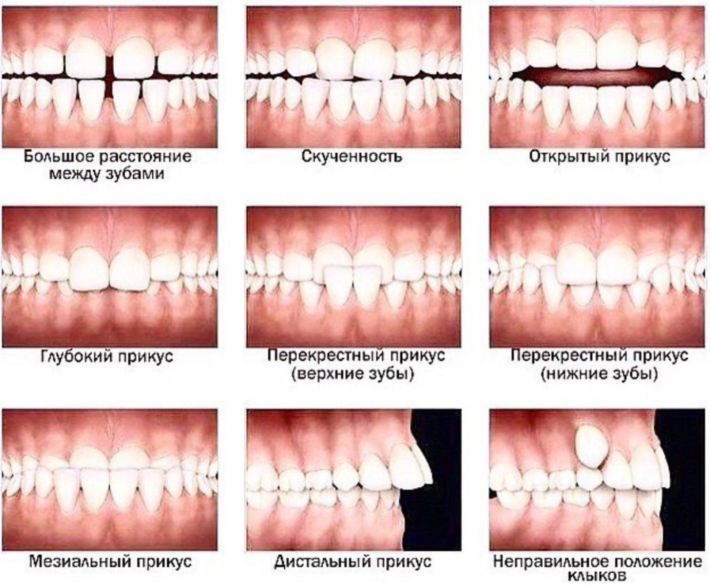 виды неправильного прикуса у детей
