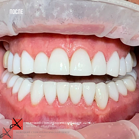 Kомплексная работа, тотальное протезирование винирами.