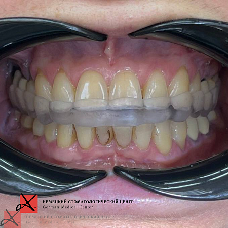 Лечение на ортотике