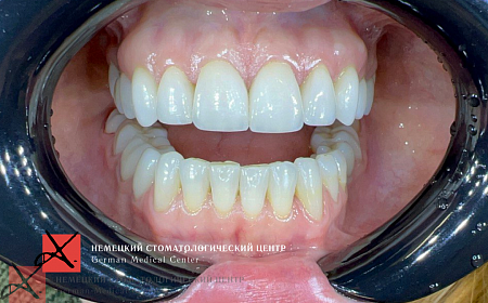 Восстановление положения нижней челюсти и функции ВНЧС