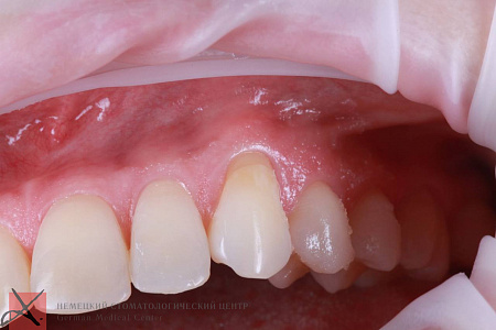 Рецессия десны