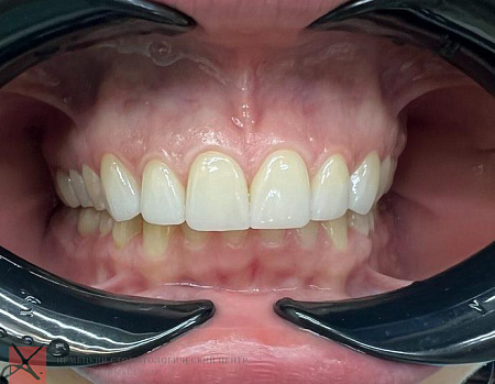 Комплексное лечение: ортодонтия + виниры 