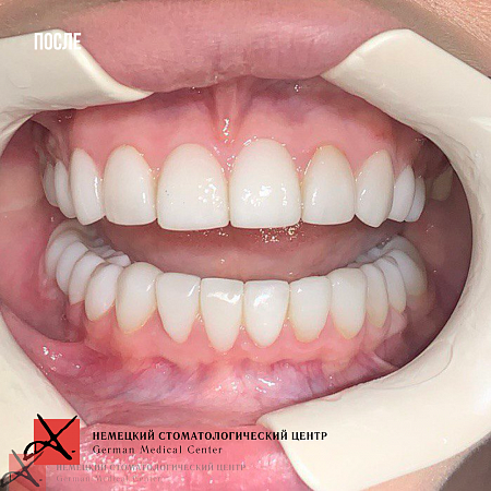 Восстановление зубов после виниров