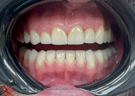 Полная реабилитация прикуса