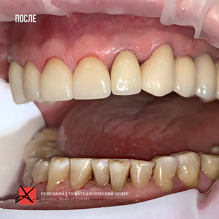 Снятие старых протезов и установка новых