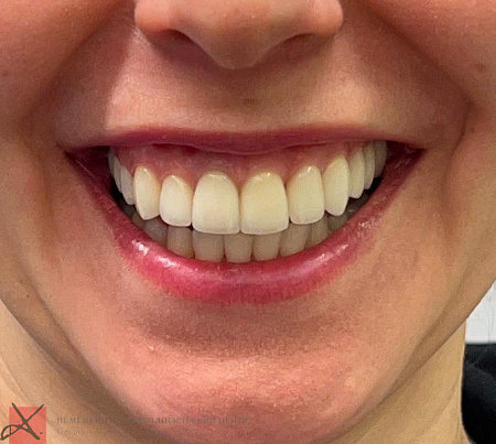 Восстановление прикуса и эстетики улыбки