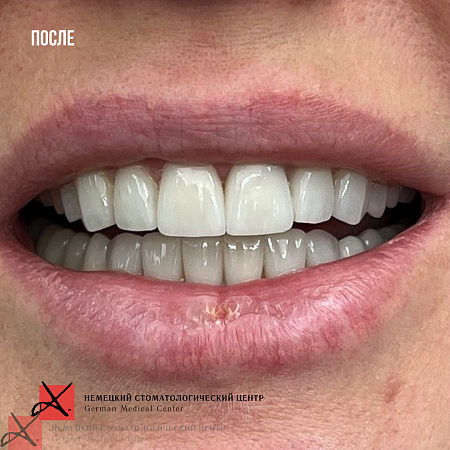 Ортодонтическое лечение и протезирование винирами